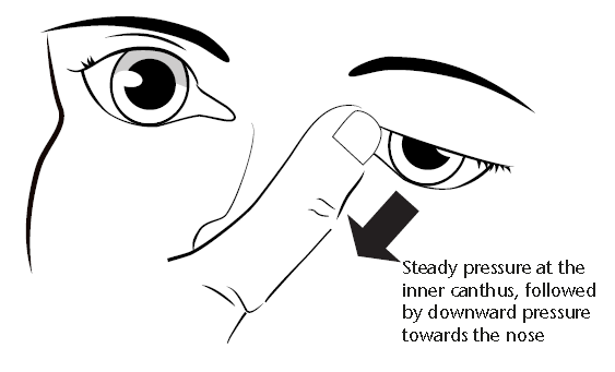 Lacrimal sac massage diagram - steady pressure at the inner canthus followed by downward pressure towards the nose.